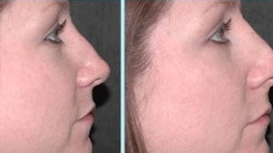 2023年中山市自體脂肪注射醫(yī)生排行榜公布，權(quán)威專家名單羅興源、李光琴、周旭剛等入選