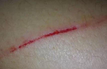 佛山美萊整形醫(yī)院抽脂療程價格高昂？效果如何？費用如何？