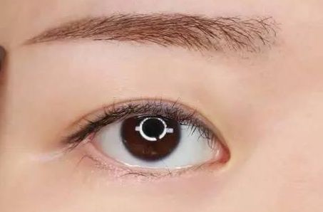 魏少魁醫(yī)生雙眼皮修復(fù)：技術(shù)及真人案例圖片分享