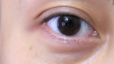 游曉波割雙眼皮的心得分享，提供割雙眼皮案例參考！