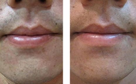 杭州銅雀臺美容整形醫(yī)院：嶄新隆胸案例分享及顧客評價(jià)揭秘