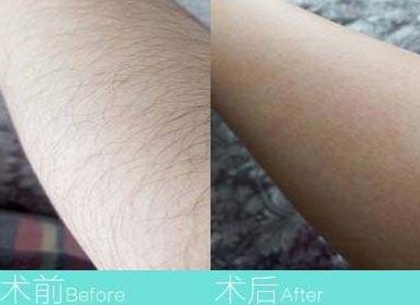 揭秘羅金超的個(gè)人資料：醫(yī)療界口碑測(cè)評(píng)帶來的真人雙眼皮果展示