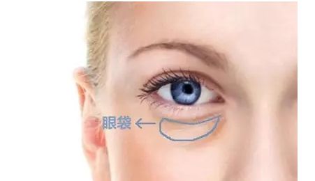 楊亞益雙眼皮修復(fù)案例分享，2023最新公布