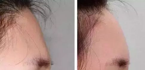 哈爾濱伊美爾醫(yī)療美容醫(yī)院，專家醫(yī)師解析與隆鼻案例分析