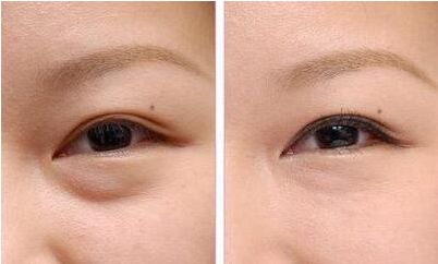 東莞陳朝陽醫(yī)生成功實(shí)現(xiàn)隆胸手術(shù)案例分享