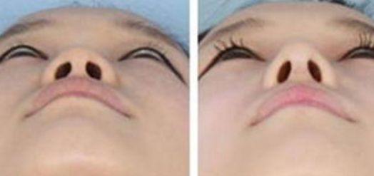 同仁醫(yī)院鄭永生雙眼皮手術(shù)效果令人驚嘆！恢復(fù)全過(guò)程揭秘