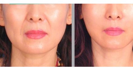 西安國(guó)際醫(yī)學(xué)整形醫(yī)院孫峰醫(yī)生的雙眼皮修復(fù)案例分享！