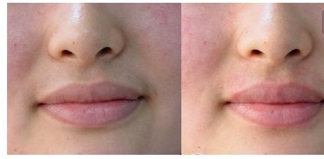 鄭州田國(guó)靜修雙眼皮效果如何？專家資料和案例分析讓你了解更多