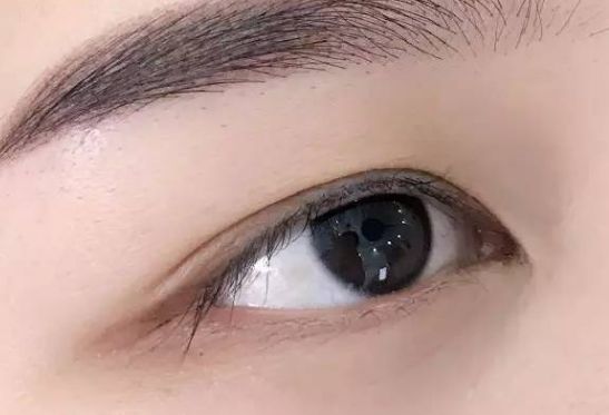 淮安華美整形：程宏宇醫(yī)生獨(dú)特技術(shù)修復(fù)雙眼皮，專屬案例分享！