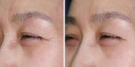 謝福庚雙眼皮手術(shù)技術(shù)及口碑評(píng)價(jià)，新上線專家報(bào)道