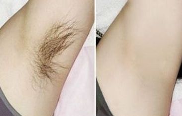 陳文莉天津雙眼皮手術效果怎么樣？獨特經(jīng)歷揭示