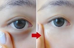 成都忠愛醫(yī)院楊忠醫(yī)生雙眼皮手術方式和費用一覽