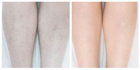 梁耀嬋豐胸術(shù)：專家經(jīng)驗(yàn)解析，全方位分享自體脂肪豐胸案例