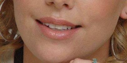 深圳春季陽光醫(yī)院最新雙眼皮技術(shù)分享