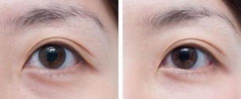 國內(nèi)熱門雙眼皮手術(shù)專家排行榜，揭曉醫(yī)生絕技