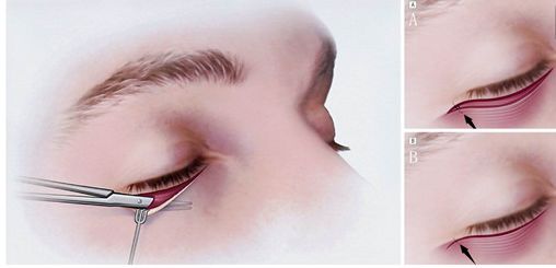 常冬青醫(yī)生的神奇術(shù)式：讓眼袋煩惱遠(yuǎn)離你！