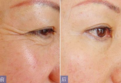 普洱市人民醫(yī)院整形科的專(zhuān)家介紹及隆胸案例分享