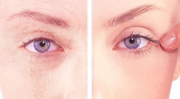 武漢美基元項(xiàng)利姣：祛眼袋30天回復(fù)細(xì)節(jié)圖大曝光！