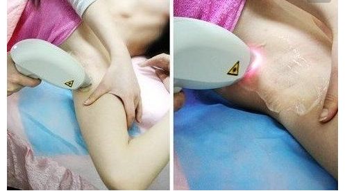 株洲市華美整形醫(yī)院近期經(jīng)驗分享：大腿吸脂恢復(fù)全過程圖曝光