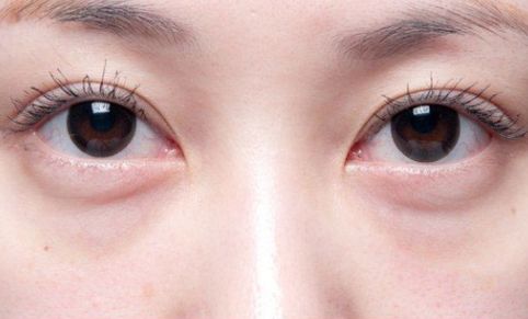 宋國棟雙眼皮恢復案例令人驚嘆！80天見證奇跡