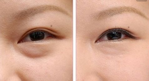 郝立君的雙眼皮經(jīng)驗(yàn)分享，顏值大突破