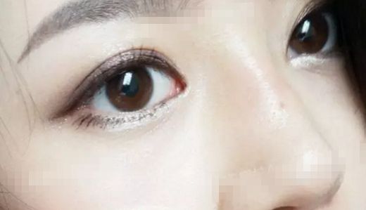 王金明雙眼修復情況如何？醫(yī)生經(jīng)驗+雙眼整形案例。