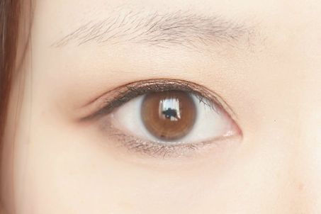 遼寧朝陽二院美容科：雙眼皮修復(fù)案例分享與費(fèi)用預(yù)估