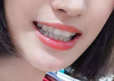 鄭東醫(yī)生鼻子整形成果揭秘！目擊案例揭示真實效果！