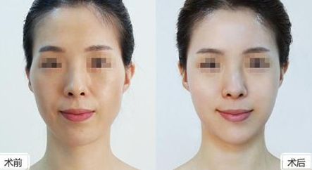 探秘歐洲之星FOTONA4D，速效消除頸紋，讓你告別滄桑紋