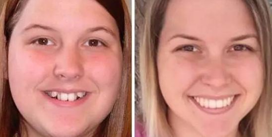 揭秘杭州奧美醫(yī)生的鼻子整形效果及價(jià)格參考