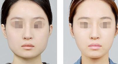 鹽城除皺美容術口碑好醫(yī)院排行  十大整形專家好評來襲