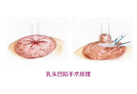 打玻尿酸對人體有何潛在風險？