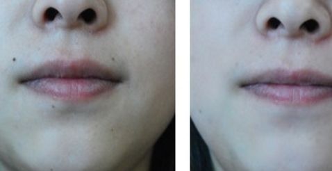 除皺針福州哪家醫(yī)院好？選擇時(shí)需考慮醫(yī)院的專業(yè)團(tuán)隊(duì)與豐富經(jīng)驗(yàn)