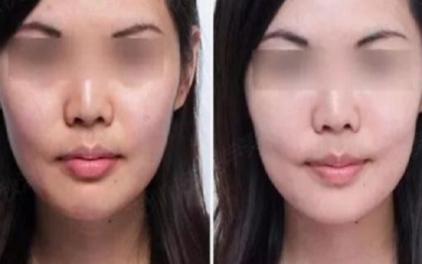 紹興哪家醫(yī)院填充鼻唇溝效果好？排名前10值得信賴的醫(yī)院推薦