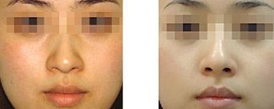 滄州專業(yè)醫(yī)美機(jī)構(gòu)之液體體雕溶脂術(shù)推薦