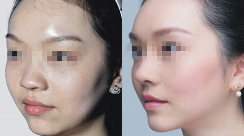 北京哪家醫(yī)院去唇紋效果好？排名前10強(qiáng)揭秘