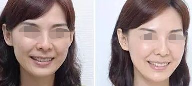 中山注射法令紋排名靠前的整形機(jī)構(gòu)一覽