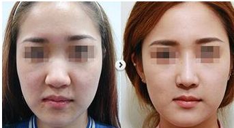 杭州哪家醫(yī)院做雙眼皮整形效果好