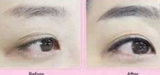 麗水選擇哪家醫(yī)院進(jìn)行激光脫毛最有效？