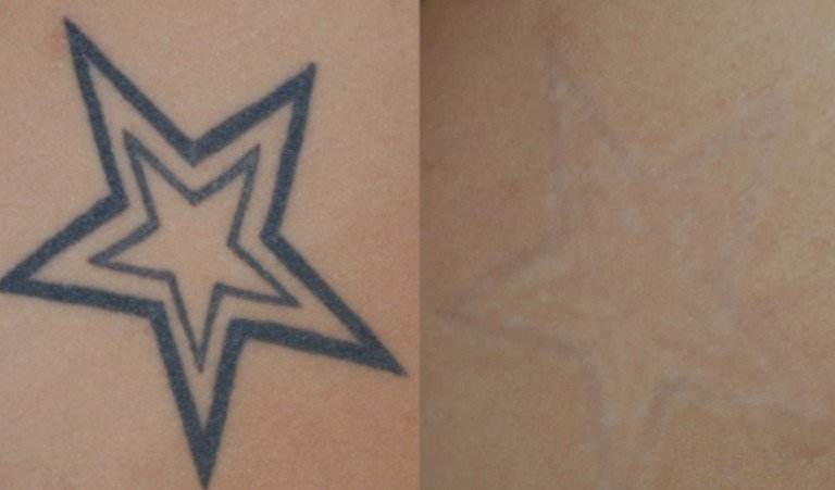 術(shù)后多久需要固定輪廓？如何正確護理？