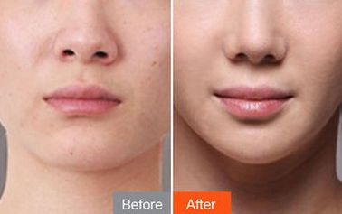 南京哪家醫(yī)院整傷疤好？專家揭秘南京整疤效果最佳的醫(yī)院