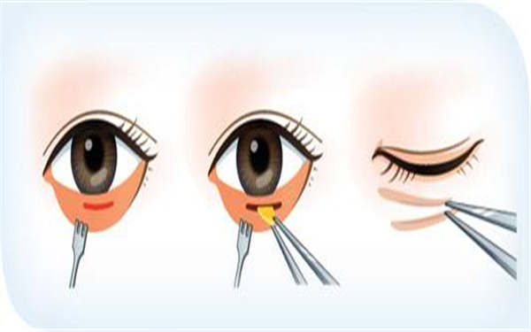 重慶魚尾紋填充醫(yī)院排名TOP10公認(rèn)靠譜