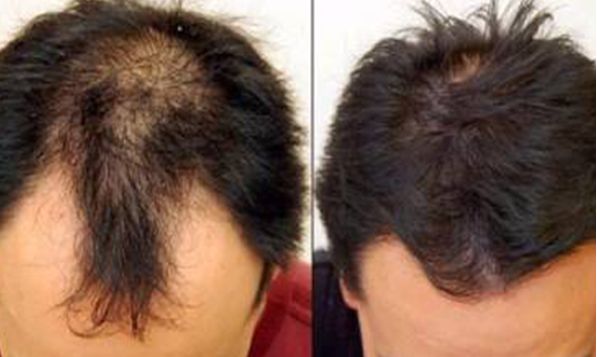 浙江省哪家醫(yī)院祛斑效果好？推薦浙江省去斑效果好的醫(yī)院有哪些？