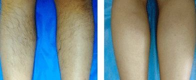 昆明哪家醫(yī)院治療疤痕效果好？專家推薦的昆明疤痕修復(fù)醫(yī)院有哪些？