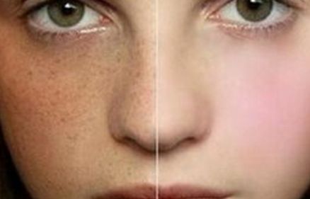 信陽拉觀眼皮哪家醫(yī)院好去哪家醫(yī)院拉觀眼皮效果好？