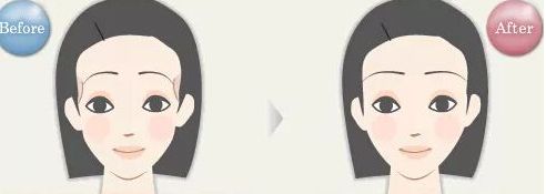 常德微針嫩膚口碑榜前十：提升美肌，見證奇跡