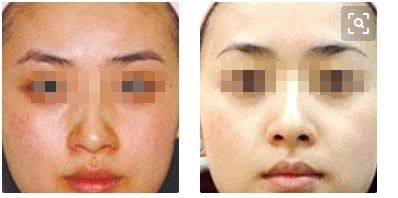 貴陽美貝爾美容醫(yī)院推薦的鼻部整形專家