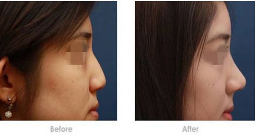 濟(jì)寧哪家醫(yī)院適合玻尿酸去黑眼圈？排名前10強(qiáng)美容機(jī)構(gòu)揭秘！