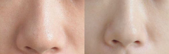 【2023最新】寧波治療痘印痘坑哪家好？專業(yè)醫(yī)師推薦