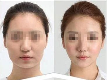 鹽城哪家醫(yī)院做玻尿酸淡化肥胖紋口碑好？推薦10家知名機(jī)構(gòu)